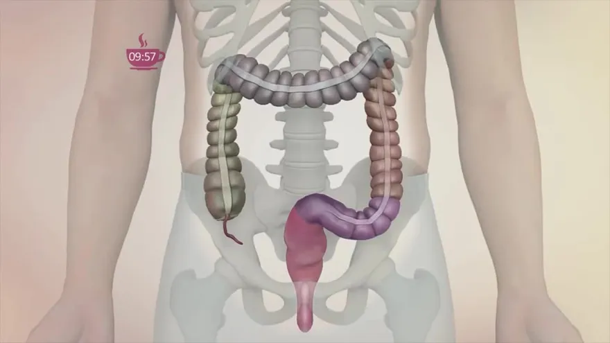 ¿Sabías que el cáncer de colon es el tercer cáncer más frecuente en Panamá?