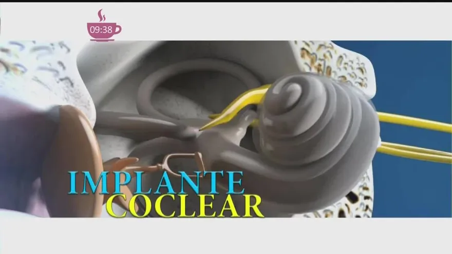 Implante Coclear, programa médico del hospital de especialidades pediátricas de la CSS