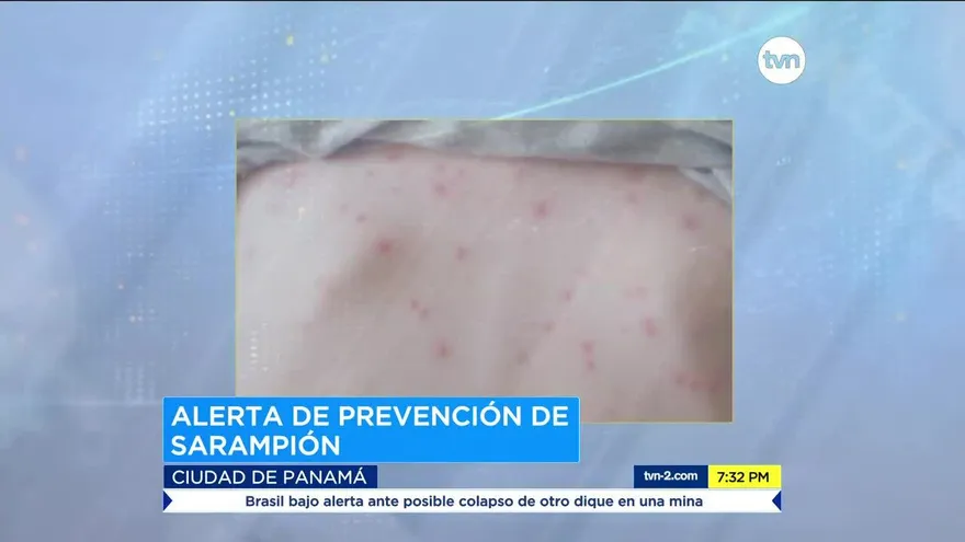 CSS emite alerta por cuadros de sarampión