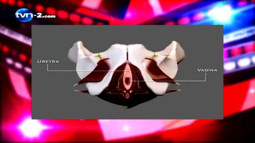 INCONTINENCIA URINARIA DE ESFUERZO