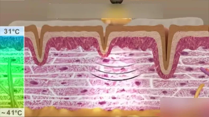 Las odiosas Arrugas te decimos qué hacer con ellas para hacerles la guerra