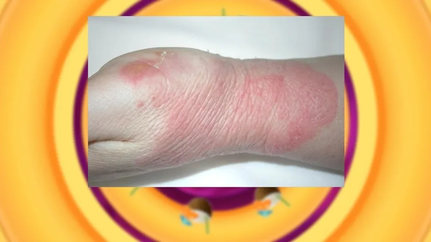 Salud al día - TEMA: erisipela  síntomas y  como tratarlo