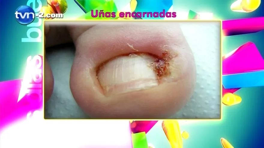 salud al día - Uñas Encarnadas