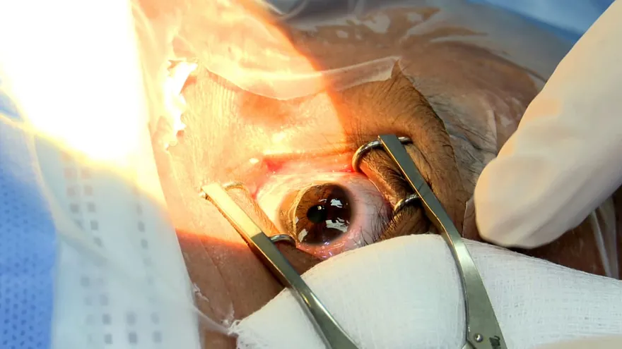 Cirugías de oftalmología