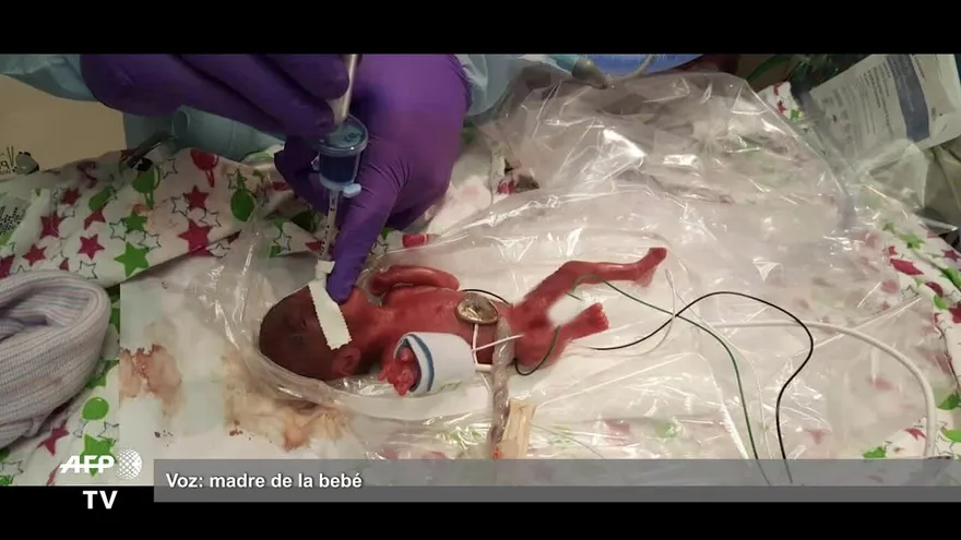 La bebé más pequeña del mundo nace en EEUU pesó lo mismo que una manzana