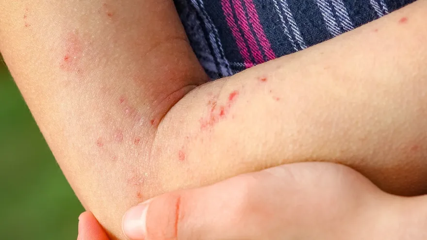 Dermatitis Atópica.