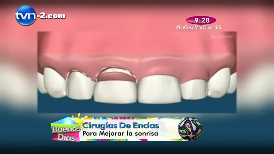 Salud Dental - Cirugías de encías, para mejorar la sonrisa