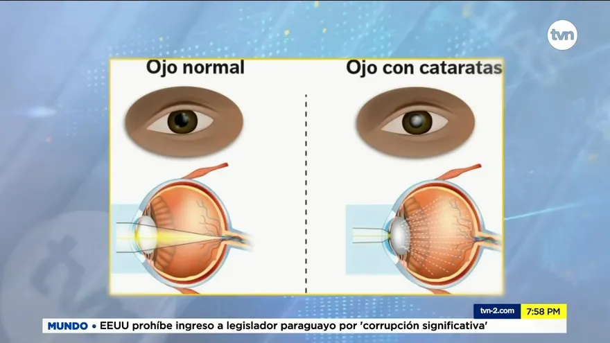 Jóvenes también sufren de cataratas