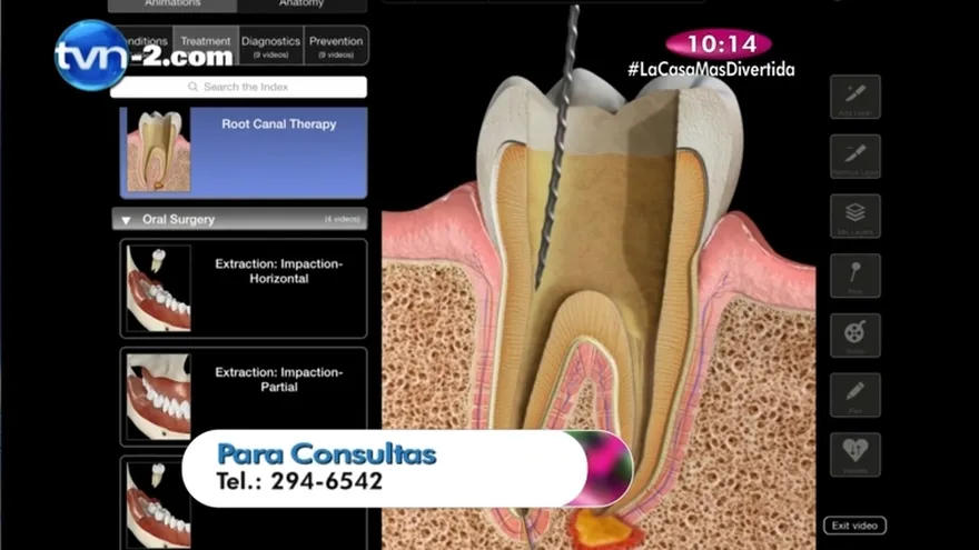 Salud dental - La Endodoncia
