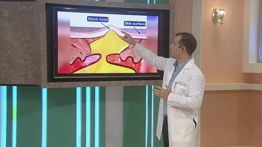 El Acné, sus secuelas y su tratamiento