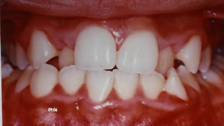 ¿Cuáles son sus causas del apiñamiento dental?