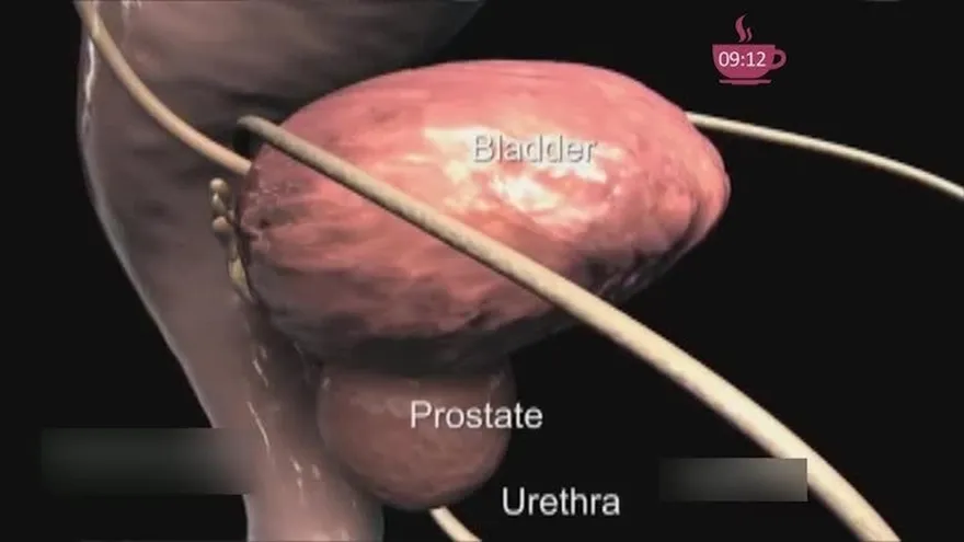 Conoce sobre el Cáncer de Próstata ¡No creas en Mitos!