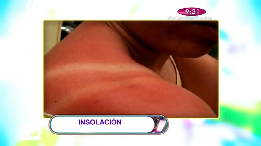 Salud al día - Para estas épocas de verano podemos llegar  a sufrir de insolación