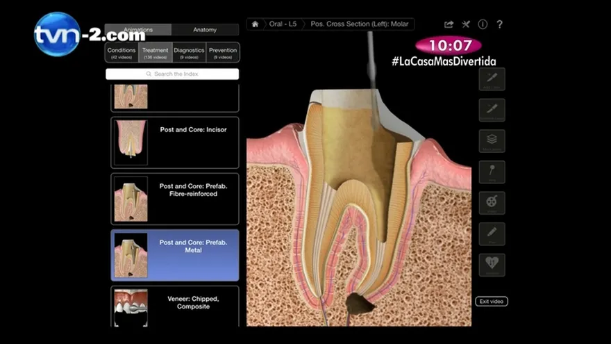 Salud Dental - La Rehabilitación Oral,Puentes Fijos