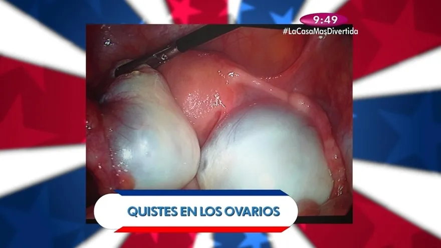Salud al día - Quistes en los ovarios