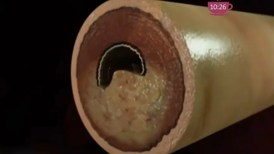 Hipertensión Arterial, la muerte silenciosa