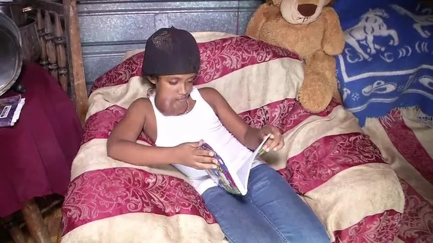 Menor con tumor en el rostro, necesita ayuda