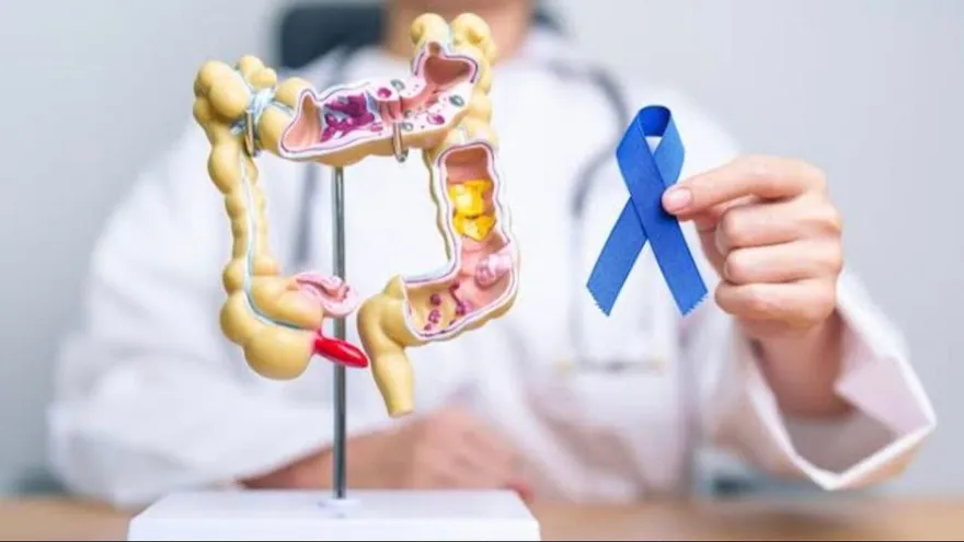 Colon cancer: A silent disease claiming lives in Panama