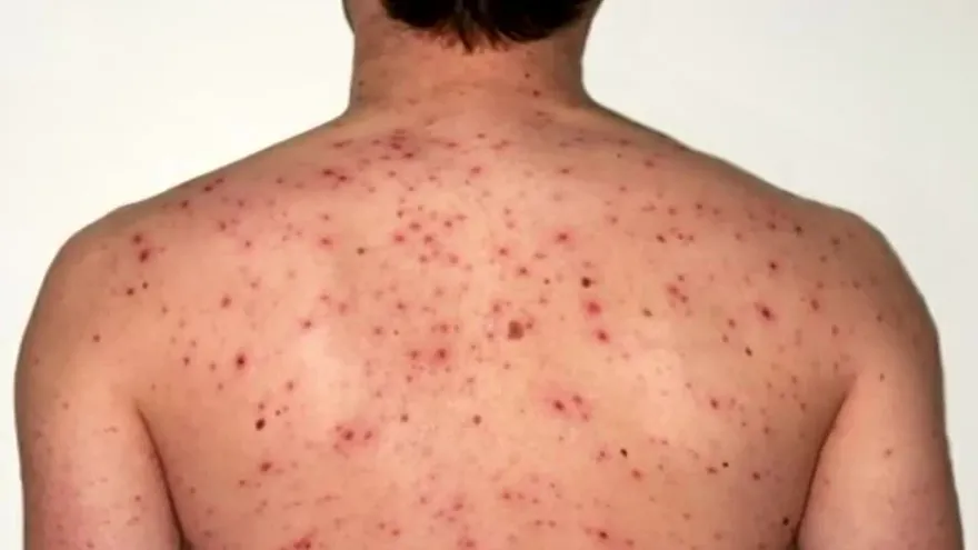 Alerta por brote de sarampión en EEUU y Europa