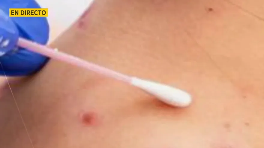 Llegan vacunas contra la viruela de mono