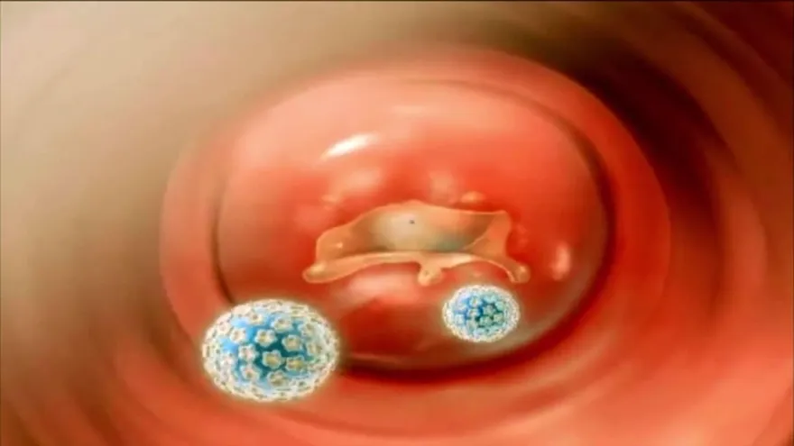 ¿Te asusta el Virus del Papiloma Humano?, ¡conócelo primero!