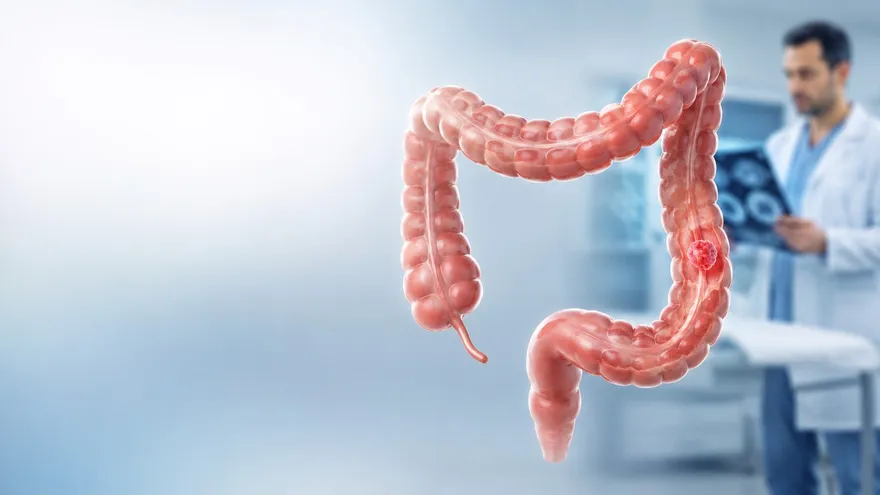 Más del 98% de los pacientes con cáncer de colon llega al Instituto Oncológico con síntomas