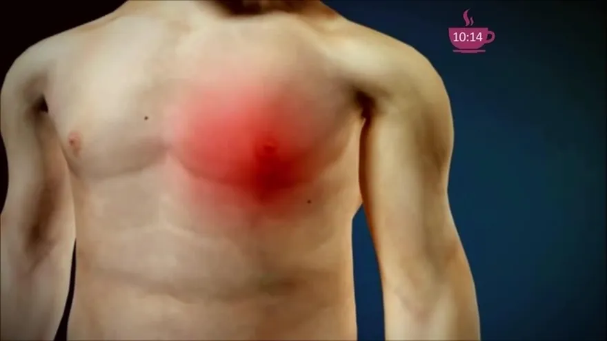 Dolores en el pecho ¡Cuidado puede ser un Infarto!