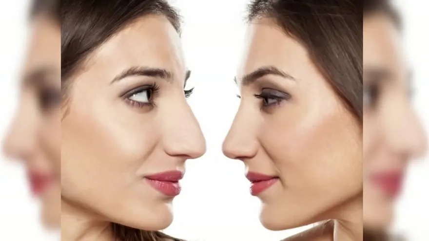 Esa nariz que  tanto quieres cambiar a perfilada lo puedes lograr  ¡Sin cirugía! Mira Cómo