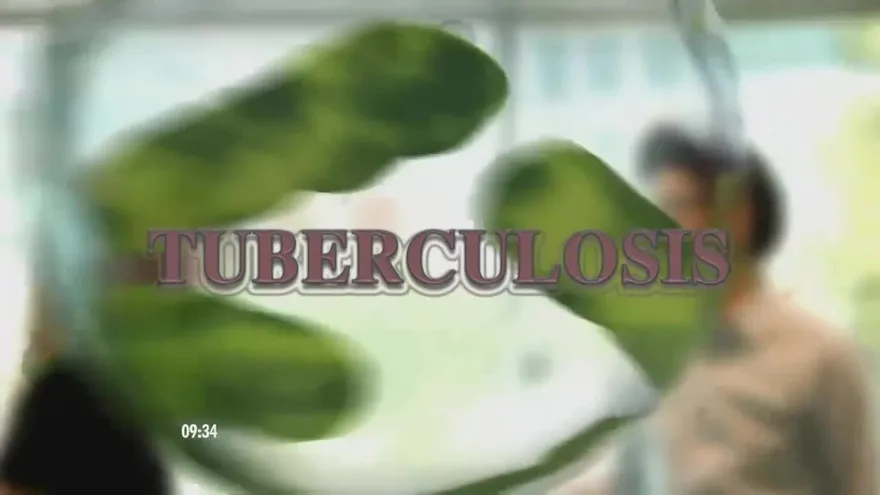 ¿Conoces cuáles son los síntomas de la tuberculosis?