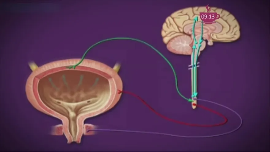 ¿Qué tanto sabes sobre la incontinencia urinaria y qué tan  grave es?