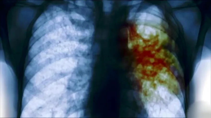 Aumentan casos de tuberculosis en Panamá