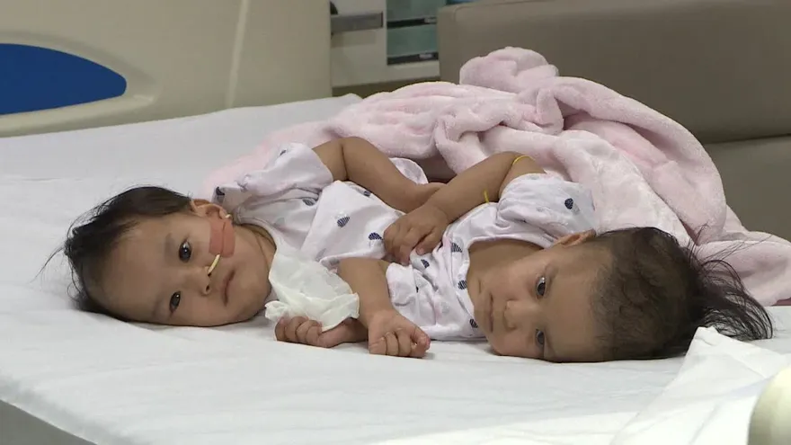 Siamesas de 15 meses separadas en Australia