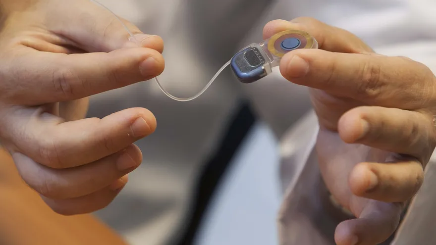 ¿Por qué el implante coclear no siempre es efectivo para mejorar la audición?