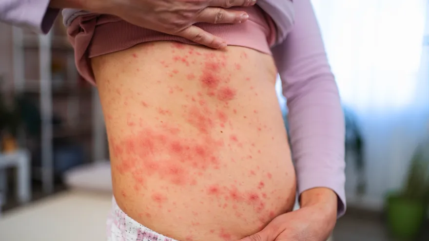 Imagen de una persona con sarampión