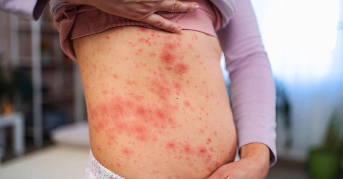 Sociedades médicas de Panamá alertan por aumento de casos de sarampión en Las Américas y llaman a vacunarse